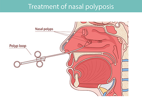 Nasal polyps Learn the facts, avoid the risks, and take control